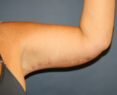 Feel Beautiful - Arm Lift San Diego30 - After Photo